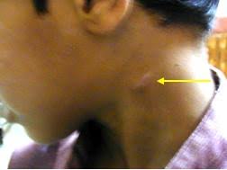 swelling in the neck