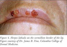 treatment of common lesions