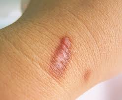 keloid scar removal u s dermatology