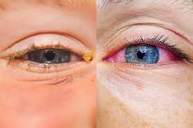 allergies or pink eye here s how to