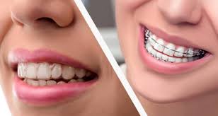 Want to know how to whiten teeth fast? Are There Alternatives To Braces Golden Pediatric Dentistry Orthodontics