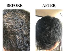 Before we tell you the hairstyles that you should focus on, we should warn you about ones to avoid. Why Do I Have A Receding Hairline At One Side Yet I Don T Lose Much Hair Daily Only 5 6 Hairs Quora