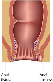 conditions anorectal abscess dr