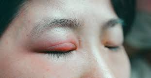 spider bite on an eyelid symptoms