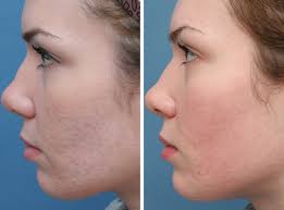 acne scar treatment chicago il dr