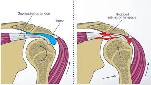 Impingement Syndrome Health And