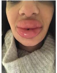botched lip filler treatment