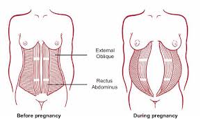 diastsis recti during pregnancy