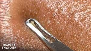 how lip blackheads are extracted