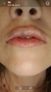 white lip color after filler photos