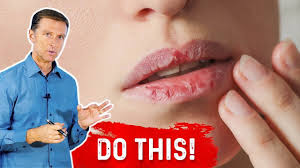 how to fix your chapped lips dr berg