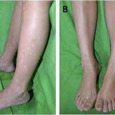 white macules on both lower limbs