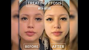 treating ptosis with botox you