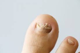 why treating toenail fungus is so important