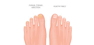 toenail fungus infection treatment and