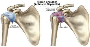 frozen shoulder treatment park sports