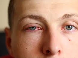 conjunctivitis pink eye symptoms
