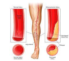is leg pain at night a warning sign of
