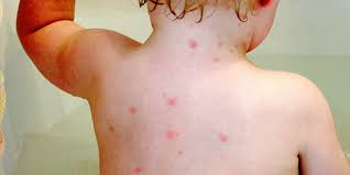 Image result for "chicken pox"
