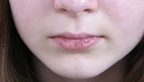 chapped lips with chron s disease