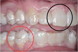 Gap teeth, or diastema, are spaces between the two front teeth. Invisalign Faq James River Orthodontics