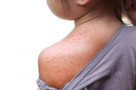 But the urge to scratch can also point to other conditions. What S My Rash Pictures And Descriptions Of 21 Rash Types Plushcare