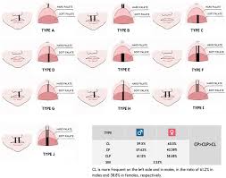non syndromic oro clefts