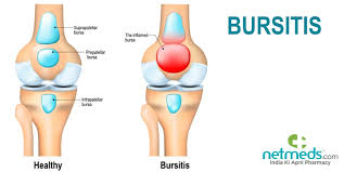 knee bursitis causes symptoms and