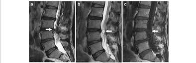 disc herniation