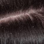 difference between lice nits and dandruff