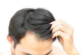 1 lack of nutrition (the main reason for hair fall). How To Regrow Hair Naturally