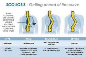 scoliosis meaning causes the best