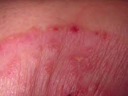 armpit rash causes and treatments