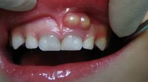 tooth abscesses midland park midland