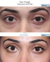 do under eye creams work eye bags