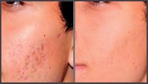 acne deep scar removal treatment at