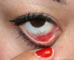 moran core what is a chalazion and