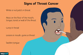 throat cancer pictures signs symptoms