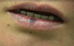 lip pigmentation treatment in singapore