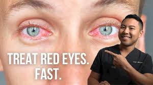 how to get rid of red eyes fast