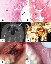 maxillary sinus mucocele