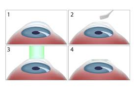 vision correction springfield balin eye