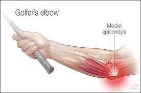 golfers elbow m physio