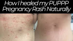 puppp rash causes symptoms and treatment