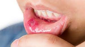 eight common infections colgate
