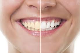 top 4 home remes for yellow teeth