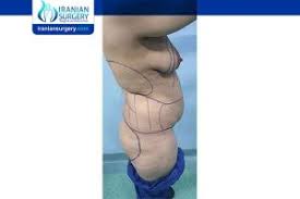 Considering a tummy tuck procedure but you're concerned about the recovery time and your surgeon will give you the best advice on how to heal, recover, and avoid here is what you can expect immediately after your tummy tuck and in the weeks and months. Bbl In Iran Bbl Surgery In Iran Before And After Review Iranian Surgery