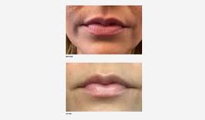 botox lip flip vs lip filler pain