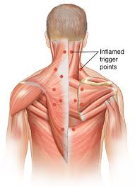 learn about trigger point injections
