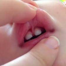 lip tongue ties virginia va doctor